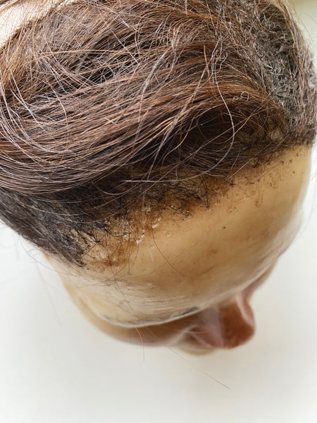 Antique Wax Medical Moulage Of A Female c.1900